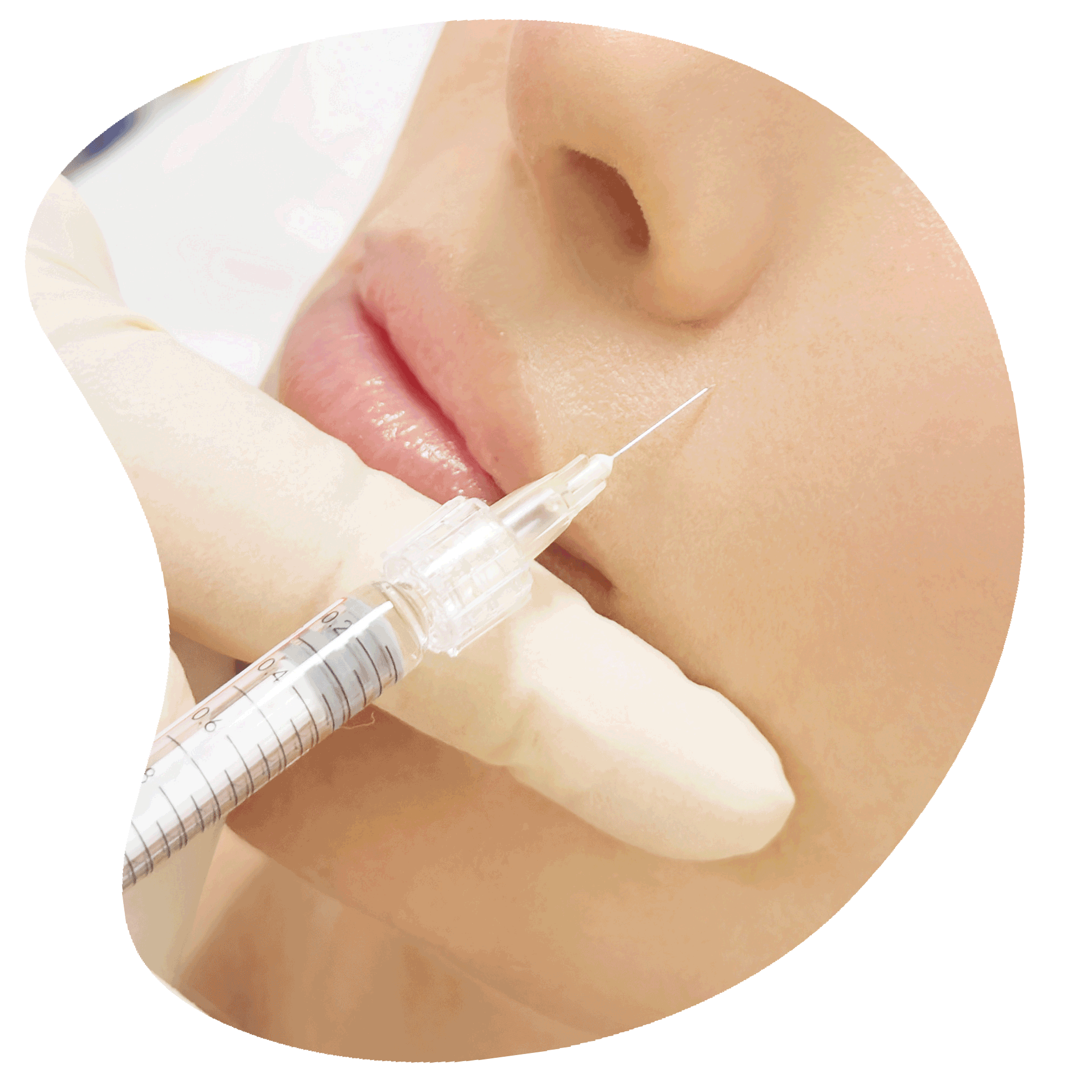 dermal-fillers