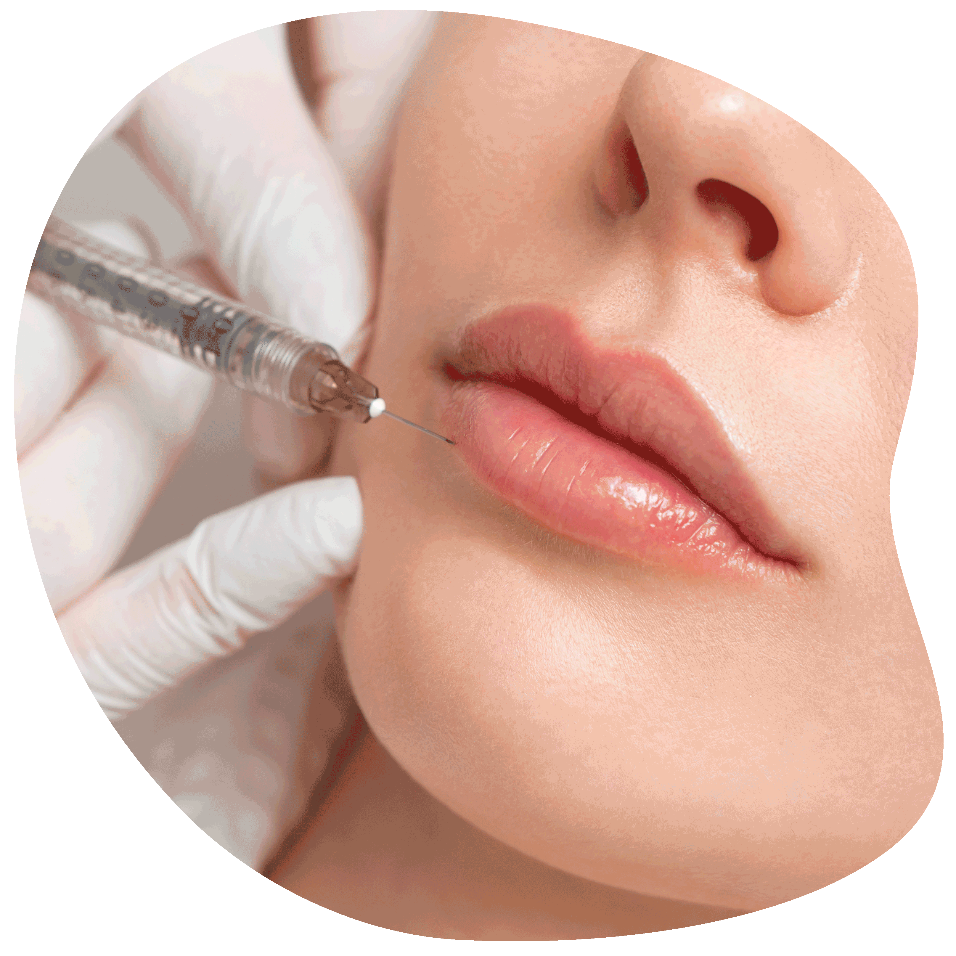 lip-fillers